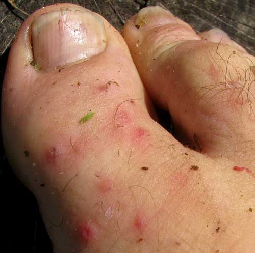 Fire Ant stung toe of hermit