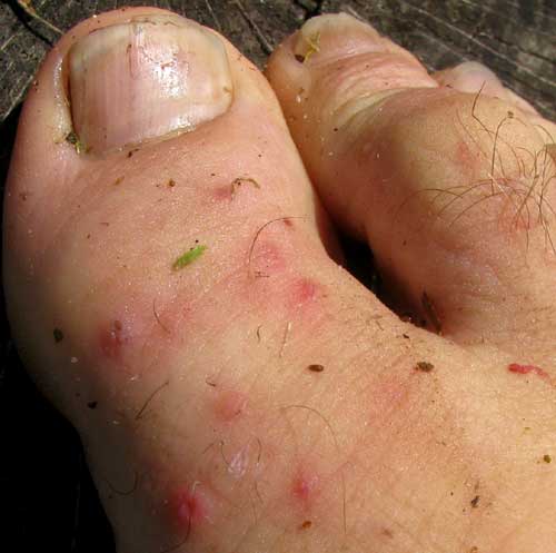 Red spots and Toe symptoms - Symptom Checker - check ...